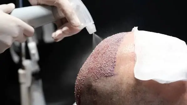 Hair Transplant An Individualized Approach