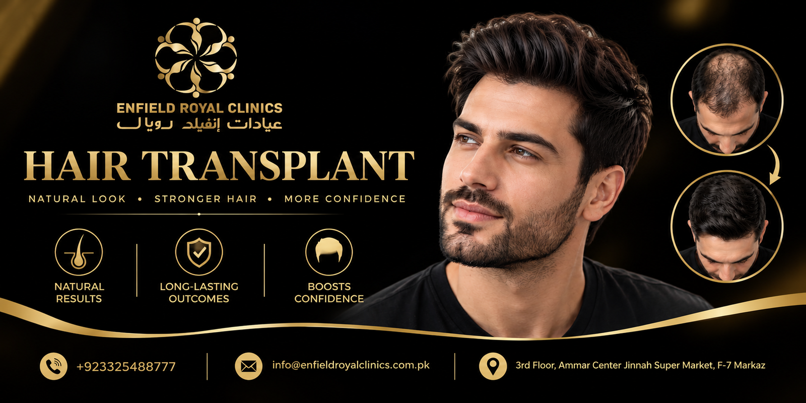 Hair Transplant in islamabad