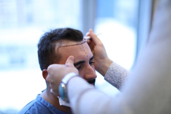 Hair transplant Surgery in Islamabad