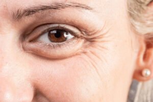 Eye Bag removal in Abu Dhabi