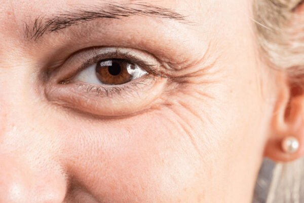 Eye Bag removal in Abu Dhabi