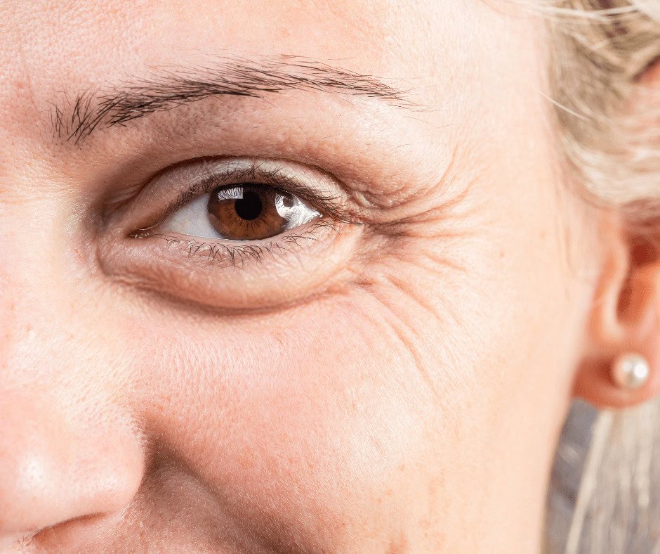 Eye Bag removal in Abu Dhabi