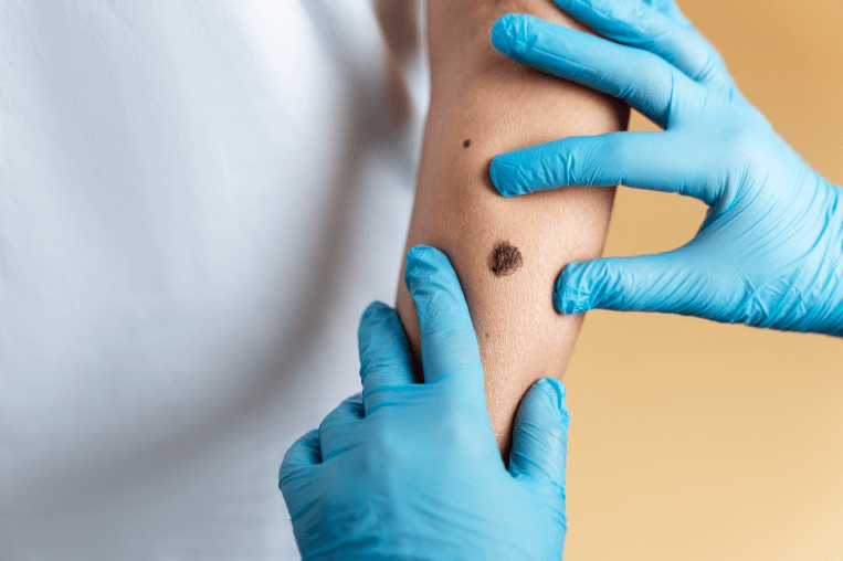 Mole Removal in Abu Dhabi