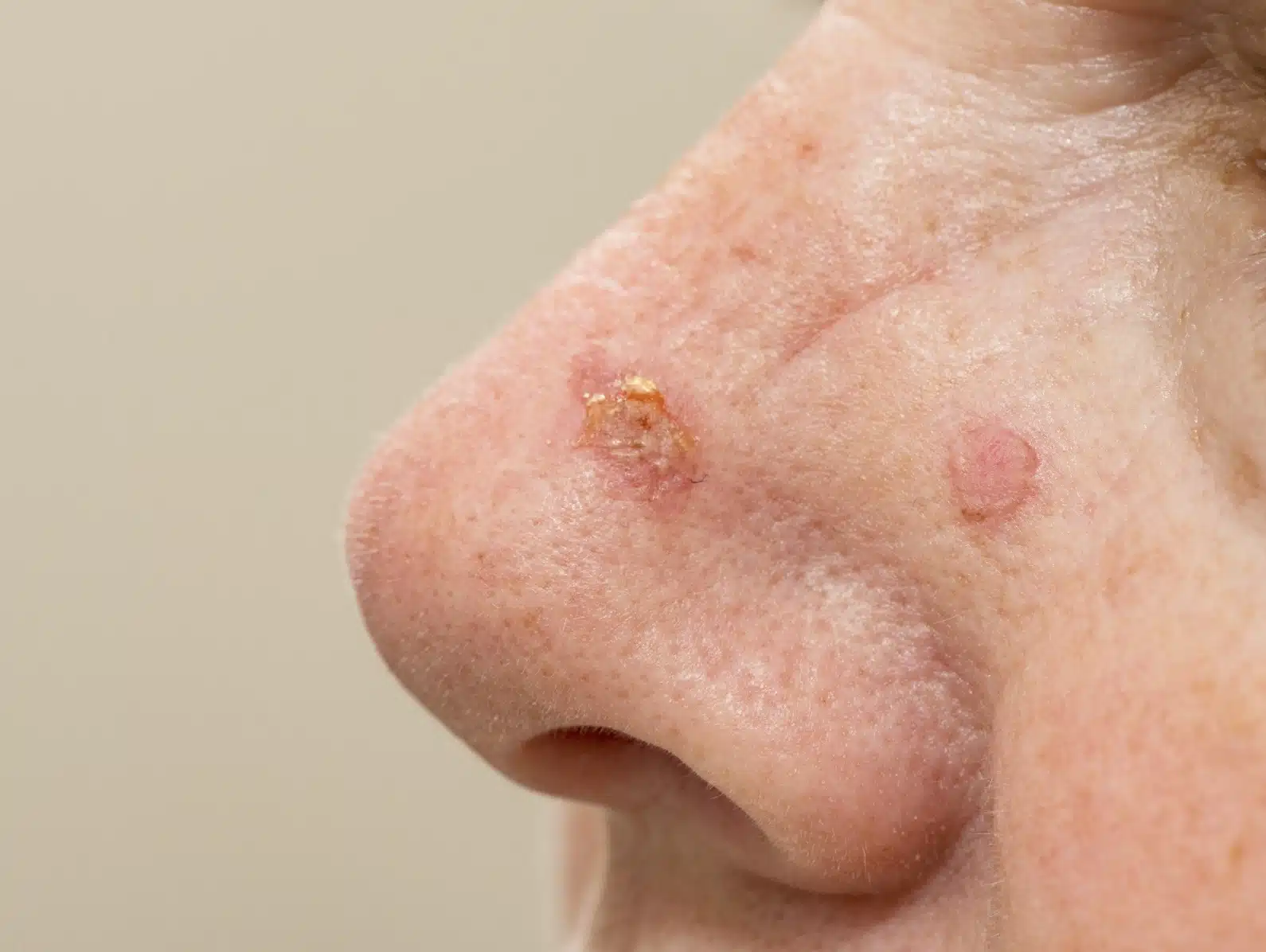 Actinic Keratosis treatment in Abu Dhabi