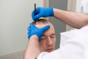 DHI Direct Hair Implant in Abu Dhabi
