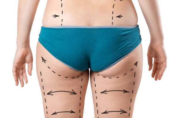 Is Lower Body Lift Suitable for Men and Women Alike