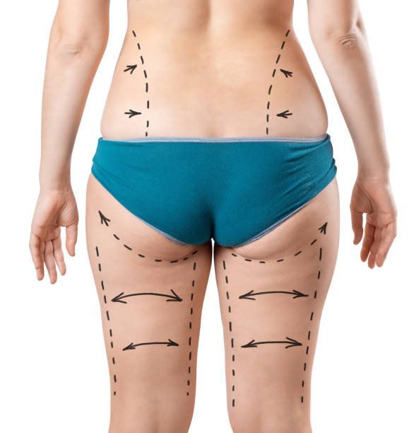 Is Lower Body Lift Suitable for Men and Women Alike