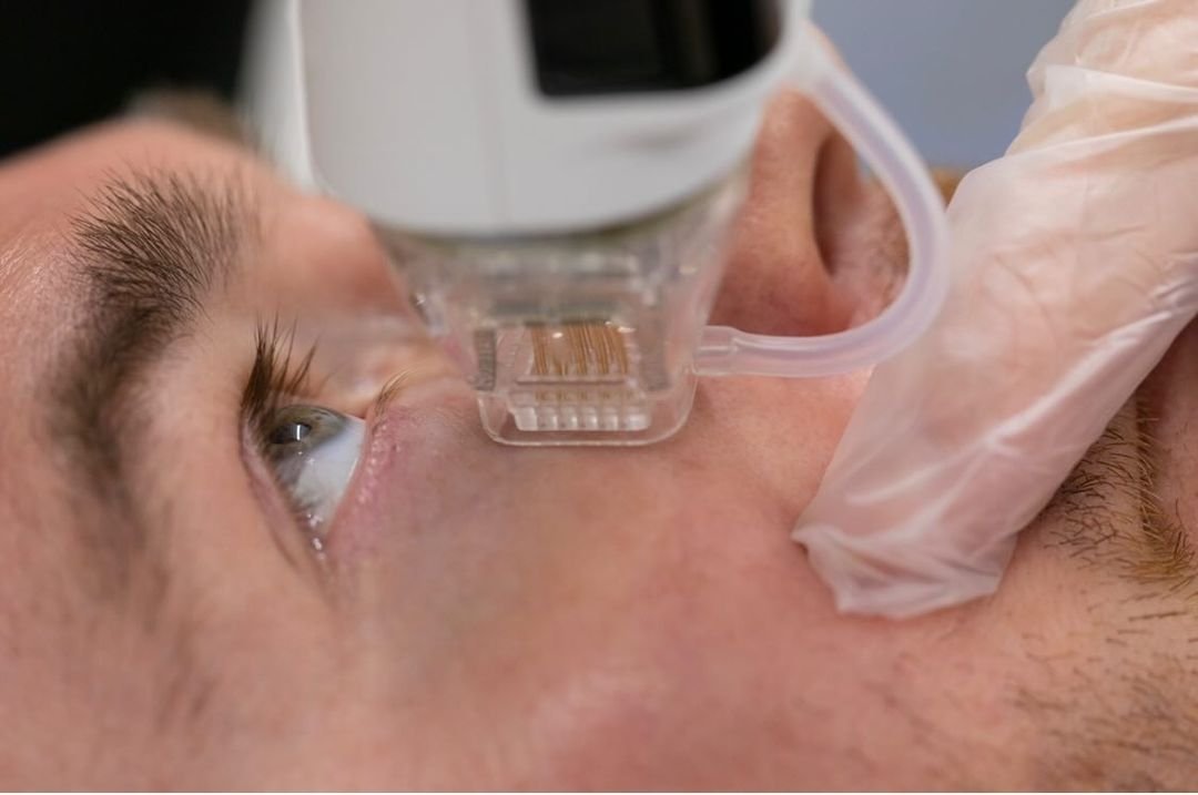 RF Micro Needling Abu Dhabi