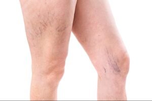 Sclerotherapy in Abu Dhabi