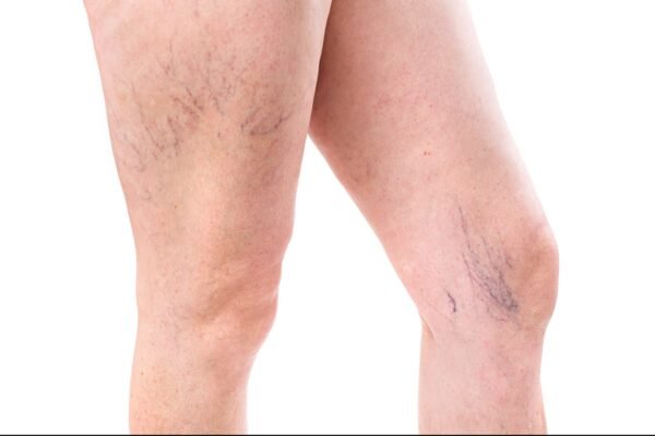 Sclerotherapy in Abu Dhabi