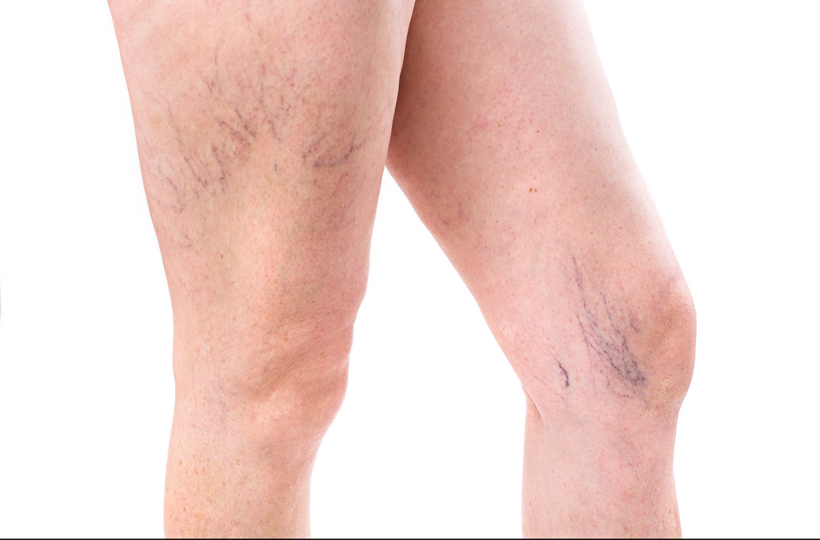Sclerotherapy in Abu Dhabi