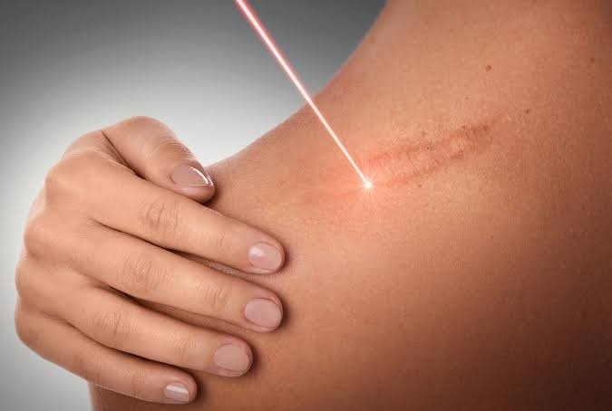 Laser Scar Removal Dubai