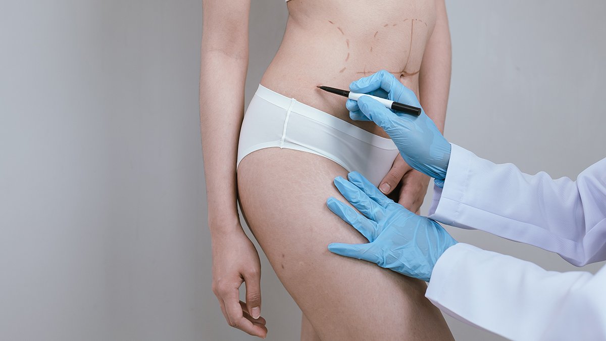 Liposuction in Islamabad