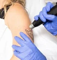 Refresh Your Look with Laser Tattoo Removal