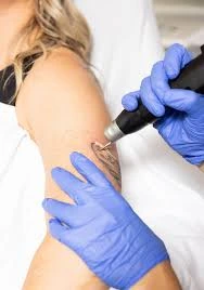 Refresh Your Look with Laser Tattoo Removal