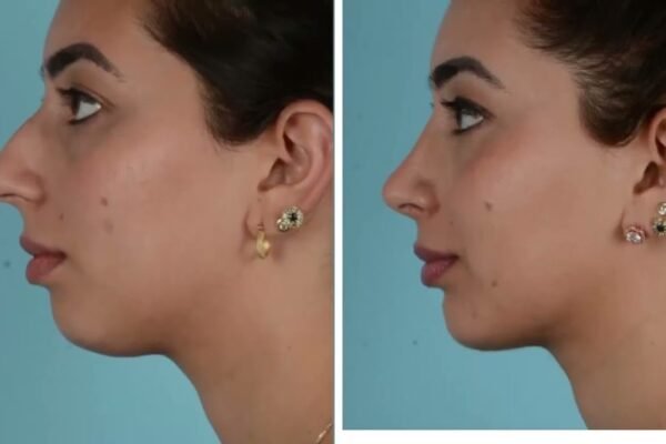 Rhinoplasty in Islamabad
