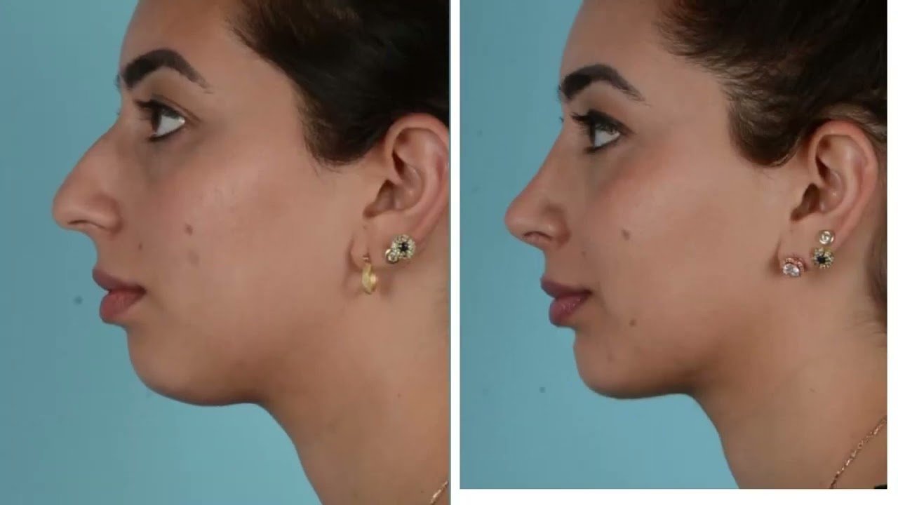 Rhinoplasty in Islamabad