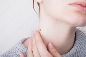 Warts Removal Treatment Abu Dhabi