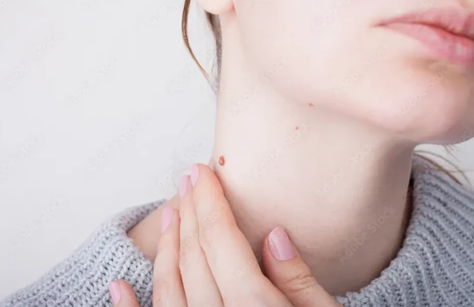 Warts Removal Treatment Abu Dhabi