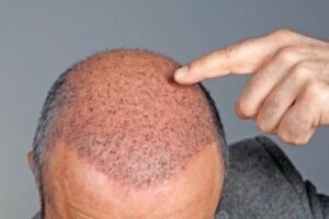 best hair transplant in islamabad
