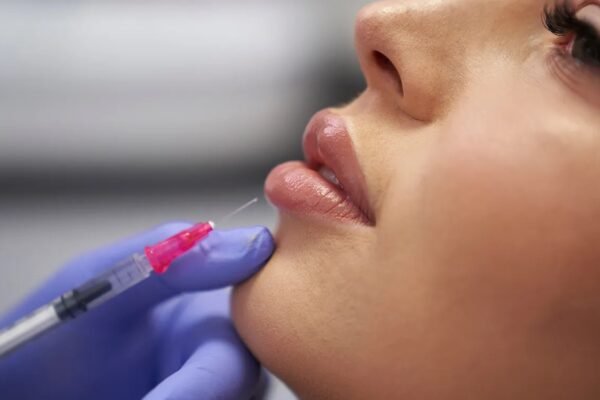 Botox Lip Flip in Dubai