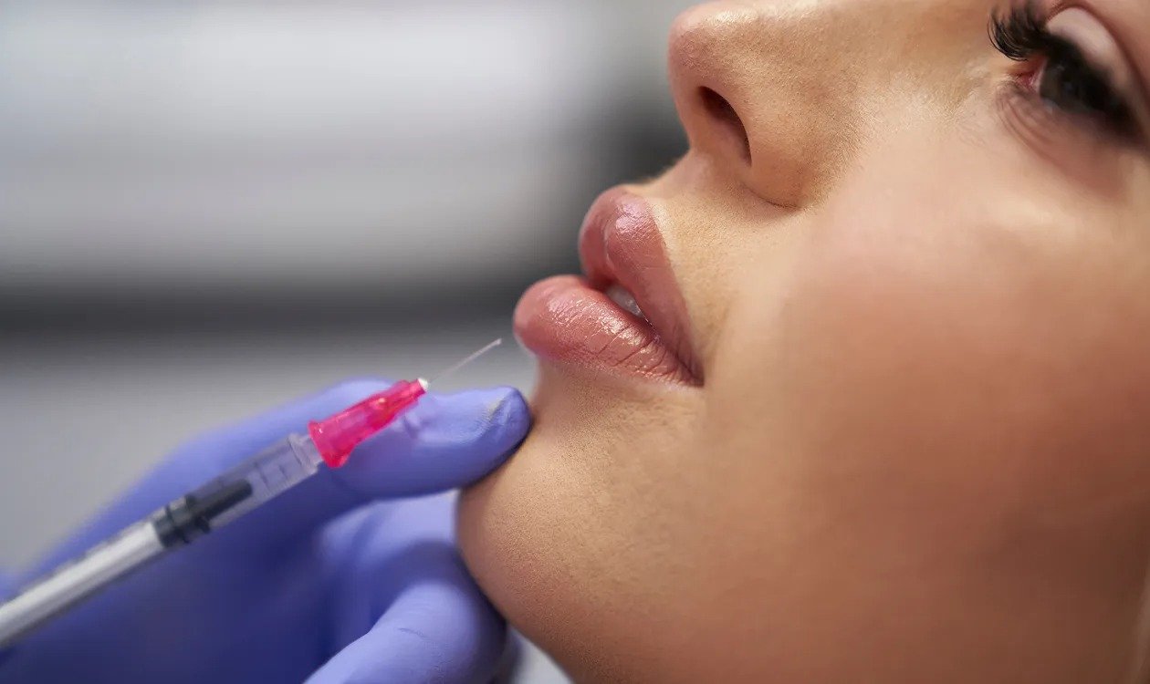 Botox Lip Flip in Dubai