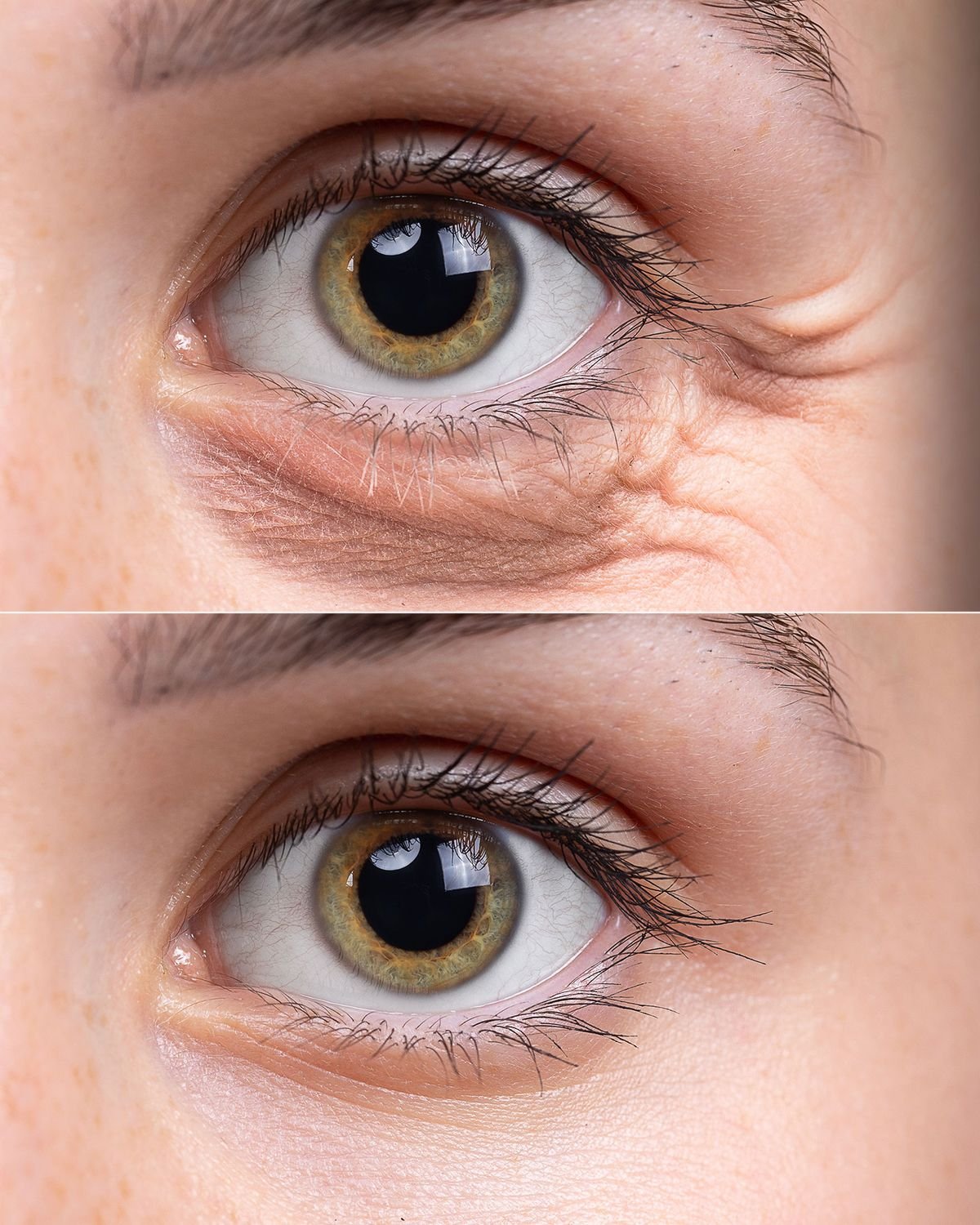 eye bag removal in islamabad