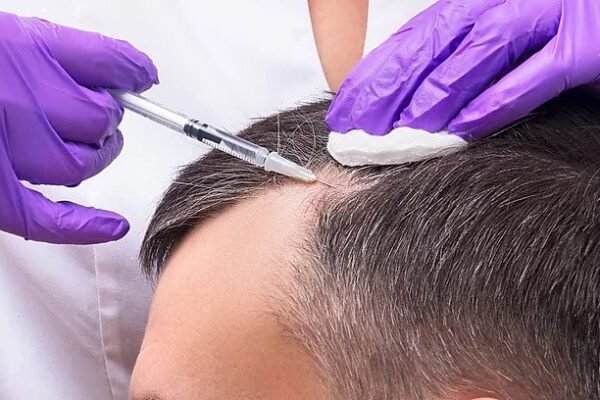 Hair Transplant in Dubai
