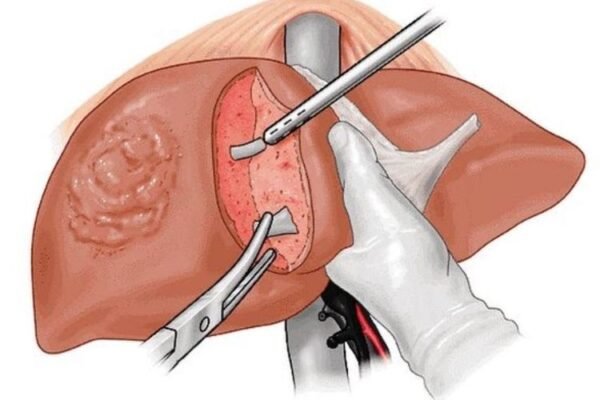 liver transplant cost in delhi ncr