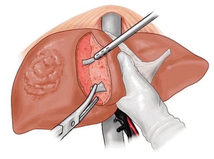 liver transplant cost in delhi ncr