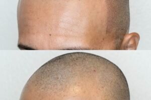 scalp micropigmentation in islamabad