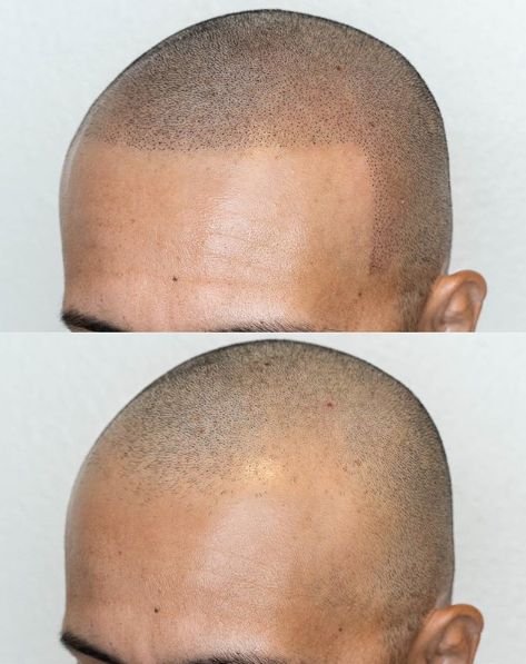 scalp micropigmentation in islamabad