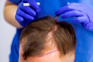 زراعة الشعر في دبي