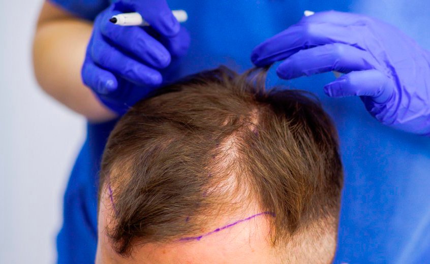 زراعة الشعر في دبي